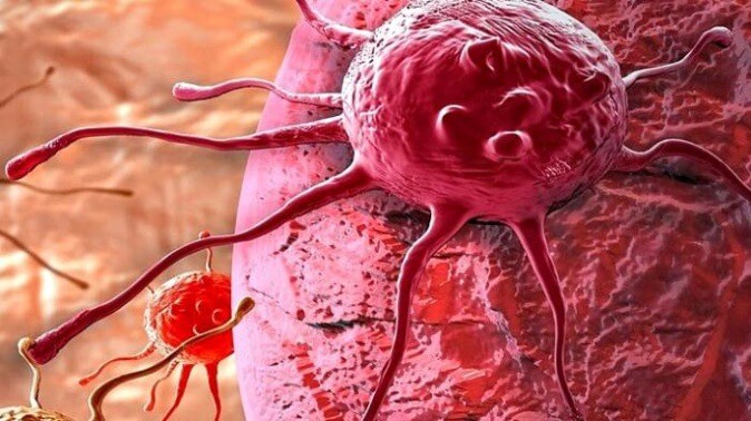 Penyebab Kanker Serviks