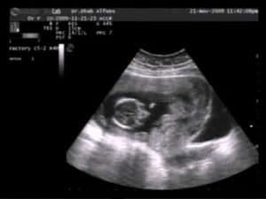 janin usia 3 bulan - hamil 3 bulan- hamil usia 3 bulannn