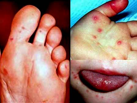 gejala flu singapura pada bayi