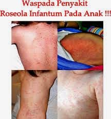 virus roseola infantum pada bayi
