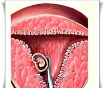 hamil pasca kuret tanpa haid, langsung hamil pasca kuret tanpa haid, tips hamil pasca kuret, mengalami hamil pasca kuret tanpa haid, merawat diri pasca kuret