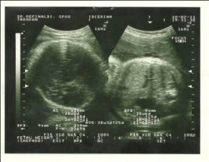 hamil 38 minggu USG 3Dimensi