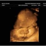 hamil 38 minggu USG 4D