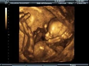 hamil 16 minggu USG 4 dimensi