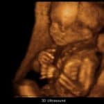 hamil 17 minggu USG 4 Dimensi posisi janin