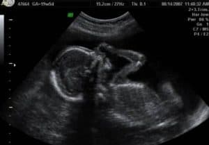 hamil 19 minggu USG 3 Dimensi