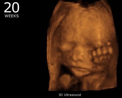 hamil 20 minggu USG 4 Dimensi