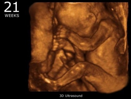 hamil 21 minggu USG 4 Dimensi