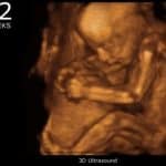 hamil 22 minggu USG 4 Dimensi