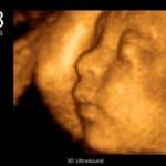 hamil 28 minggu USG 4 dimensi