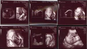 hamil 24 minggu USG 3 Dimensi bentuk janin 24 minggu