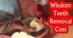 Teeth Removal Cost Teeth Removal Cost Teeth Removal Cost