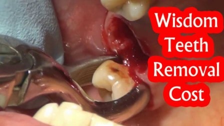 Teeth Removal Cost Teeth Removal Cost Teeth Removal Cost
