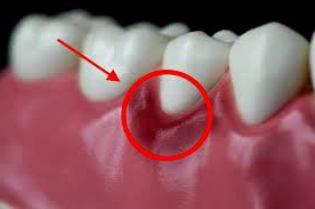 Cara mengatasi gusi bengkak