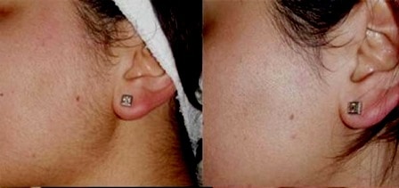 Cara Menghilangkan Bulu di Wajah