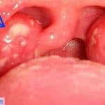 pantangan makanan faringitis (buah untuk penderita radang tenggorokan) pantangan makanan faringitis, radang tenggorokan makanan yang dihindari, buah untuk penderita radang tenggorokan