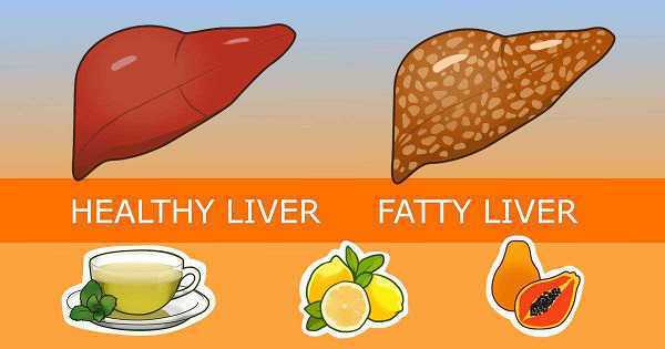pantangan makanan fatty liver, cara mengobati fatty liver, jenis susu untuk penderita liver pantangan makanan fatty liver cara mengobati fatty liver, jenis susu untuk penderita liver