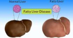 pantangan makanan fatty liver (cara mengobati fatty liver, jenis susu untuk penderita liver)