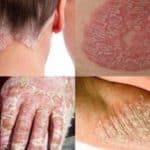 jenis penyakit kulit karena jamur, eksim dan yang menular