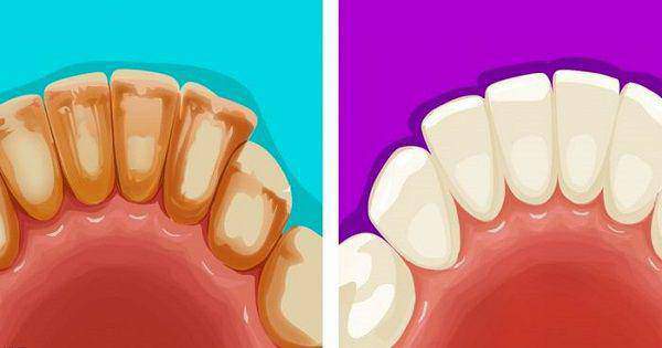 cara menghlangkan plak gigi